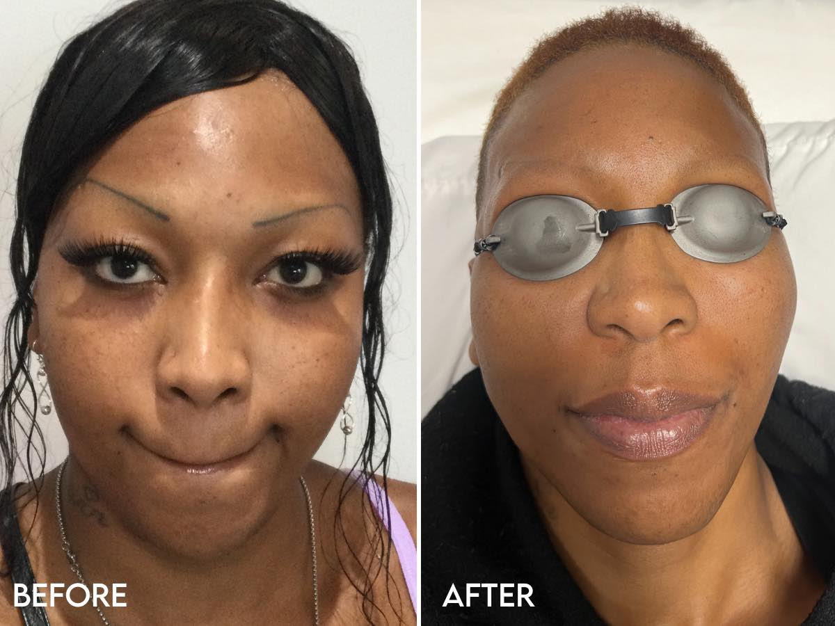 Permanent makeup removal procedure