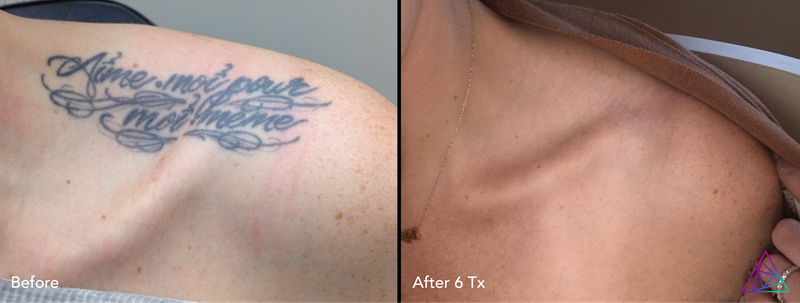 Laser tattoo removal procedure
